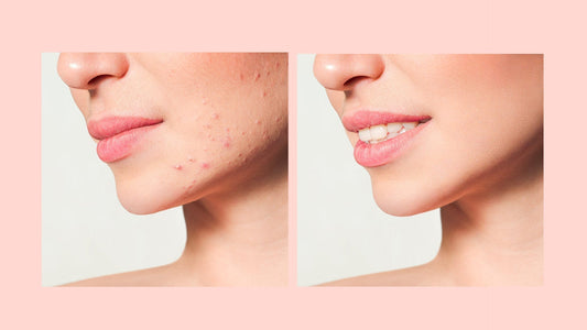 Viso con imperfezioni cutanee dovute a Skin Purging a sinistra e lo stesso viso senza imperfezioni a trattamento concluso con pelle rigenerata a destra.