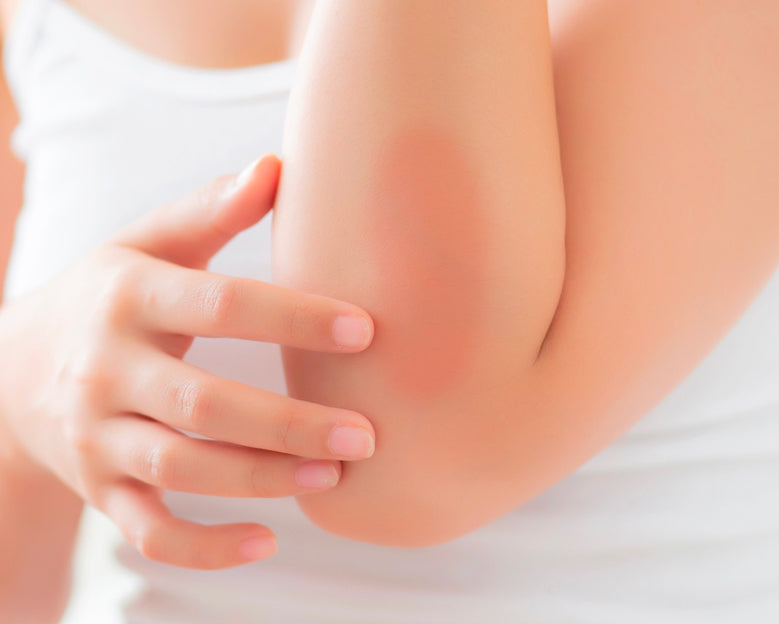Donna che applica crema alla bava di lumaca naturale sul gomito arrossato