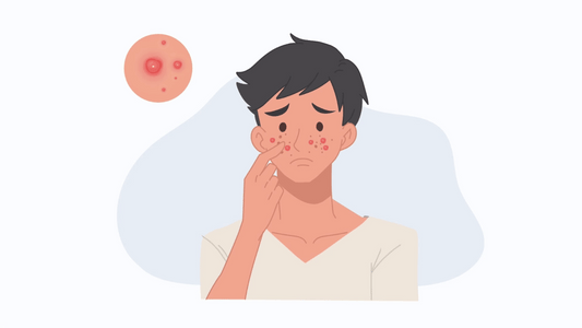 Illustrazione di un giovane ragazzo con acne in guarigione