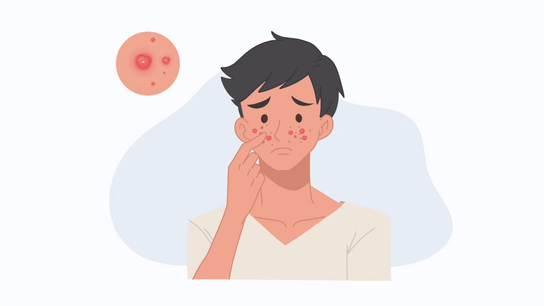 Illustrazione di un giovane ragazzo con acne in guarigione