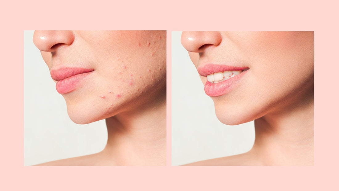 Viso con imperfezioni cutanee dovute a Skin Purging a sinistra e lo stesso viso senza imperfezioni a trattamento concluso con pelle rigenerata a destra.