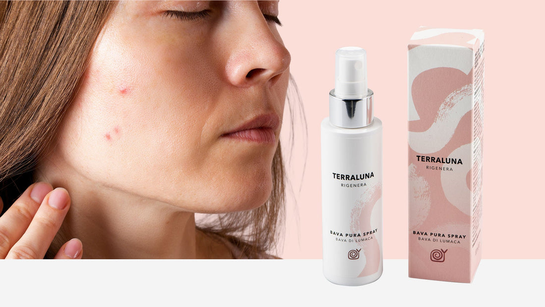 Donna con pelle impura e disidratata e Bava pura spray Terraluna