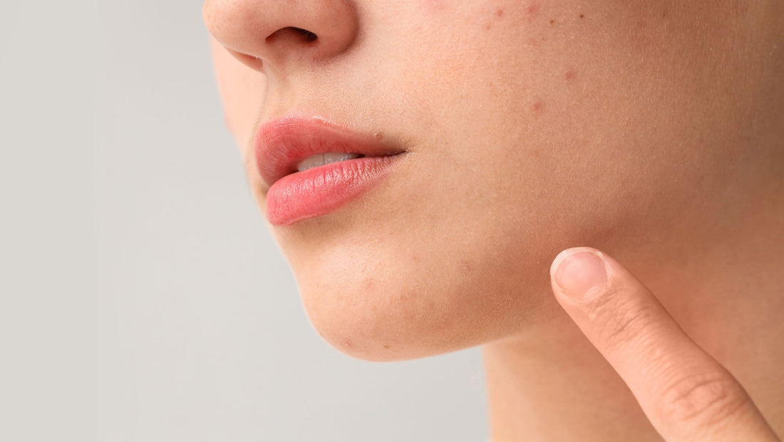 Donna che punta al suo viso, rappresentando i rimedi naturali per i brufoli e la cura della pelle